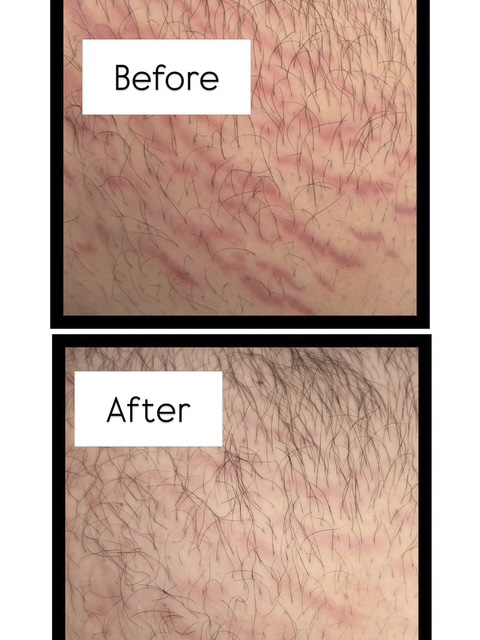 Stretchmarks before and after